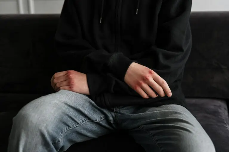 Teenage boy with bruised hands wearing hoodie sitting alone on couch.
