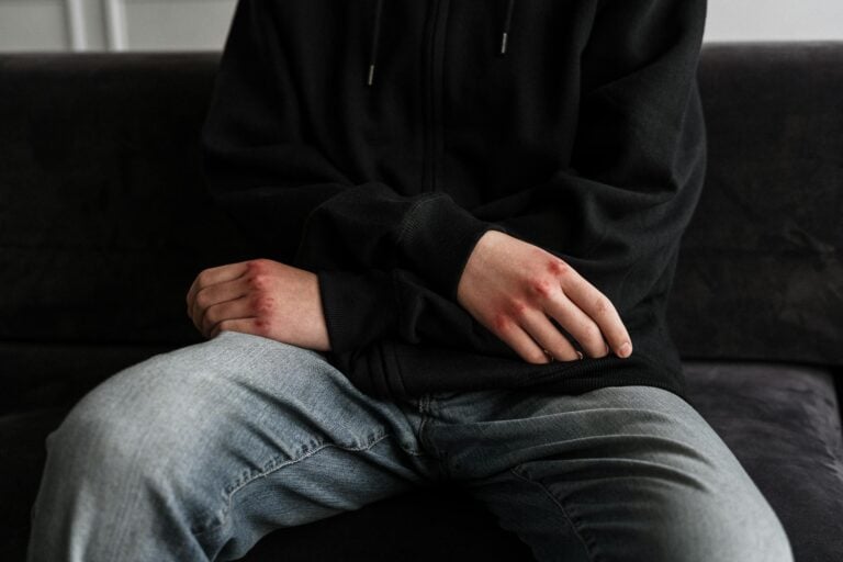 Teenage boy with bruised hands wearing hoodie sitting alone on couch.