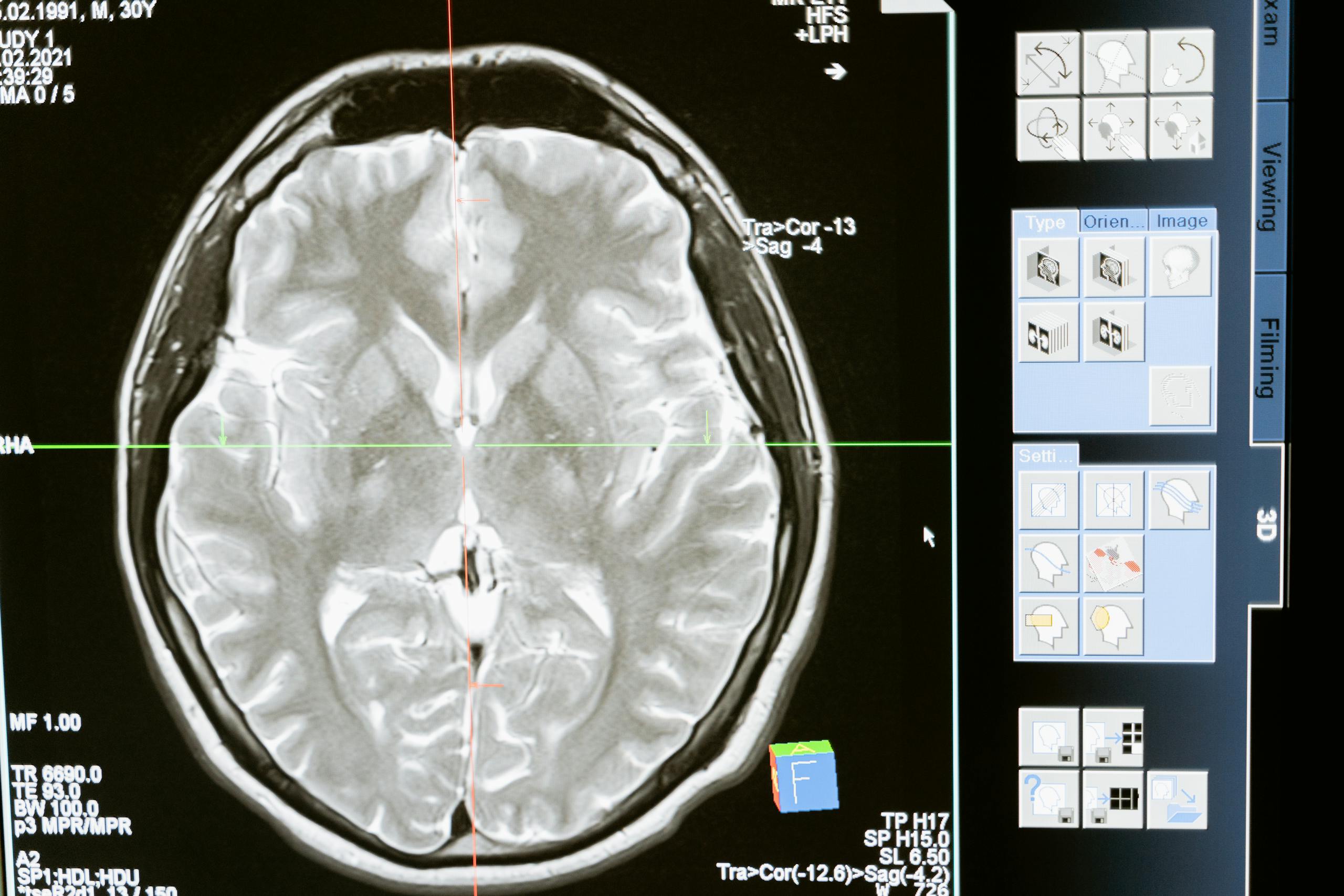 Intricate MRI brain scan displayed on computer screen for medical analysis.